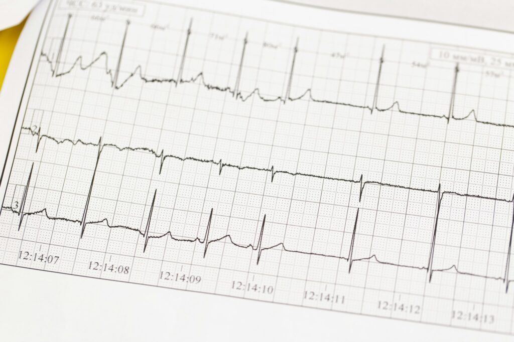 Close Up Of Ecg, Electrocardiogram. The Work Of A Healthy Heart On Paper.