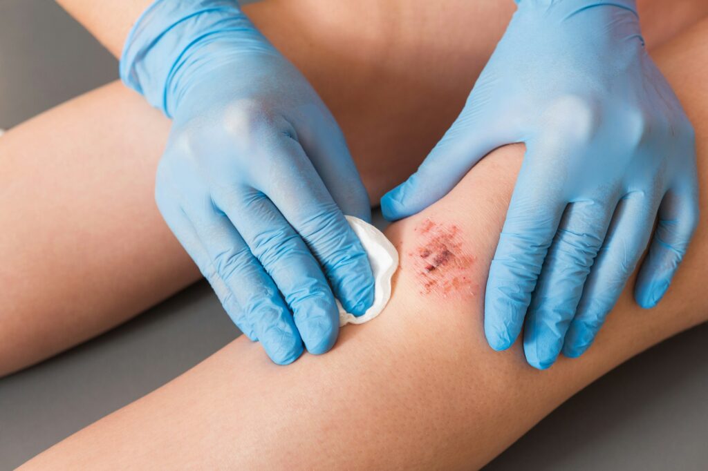 Injured Leg Wound Knee With Blood And Doctor'S Hands In Blue Medical Gloves Treats A Patient