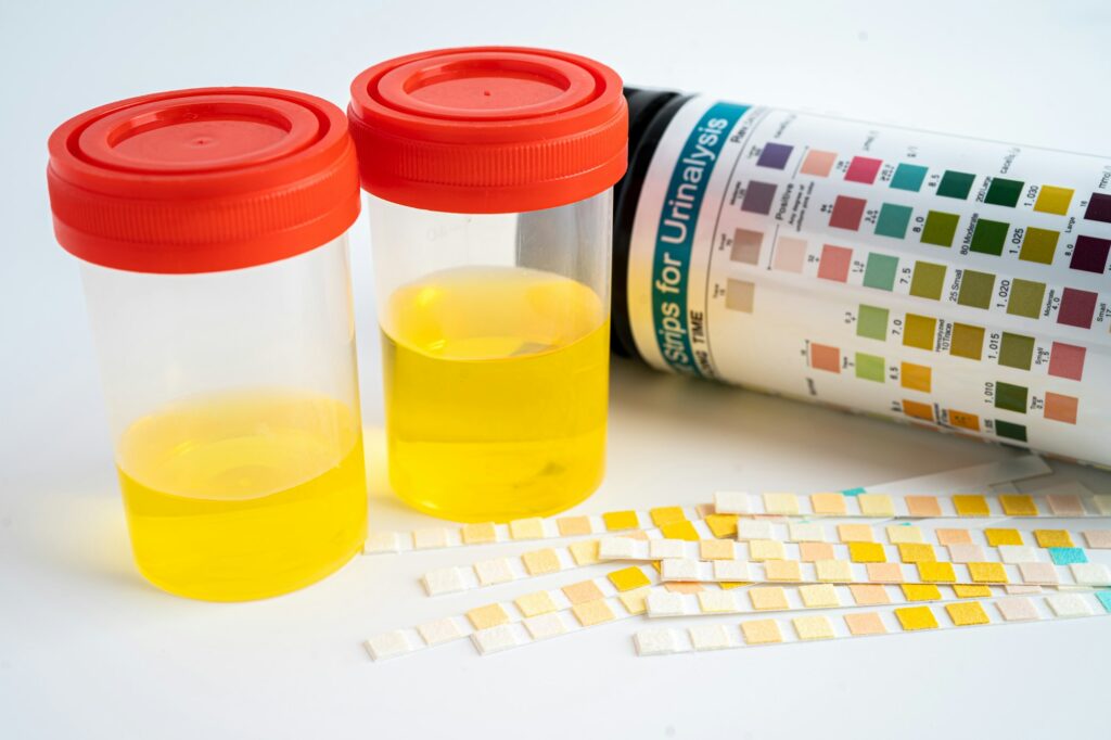 Urinalysis, urine cup with reagent strip pH paper test and comparison chart in laboratory.